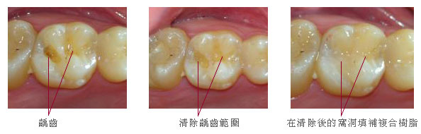 常見的牙齒問題