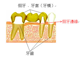 假牙.牙套